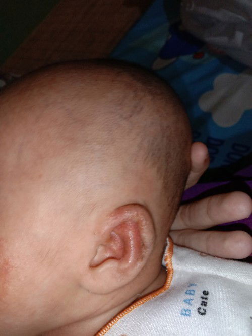 Telinga merah, berair