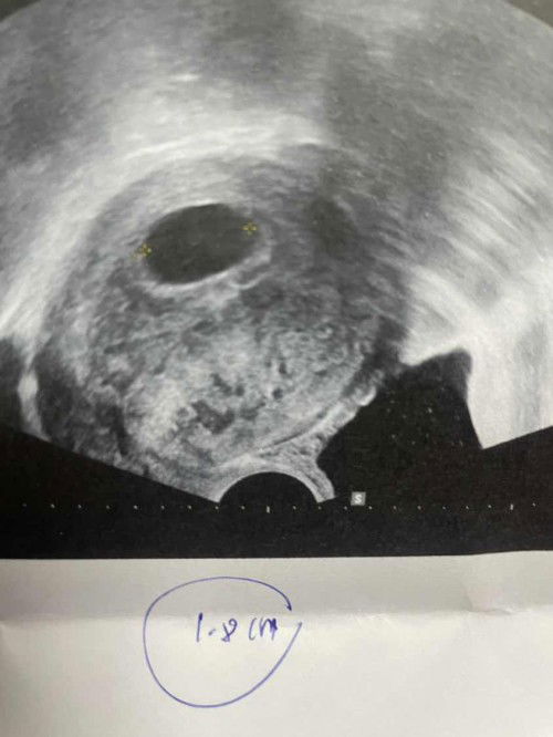 สอบถามแม่ๆที่เคยท้องลมค่ะ