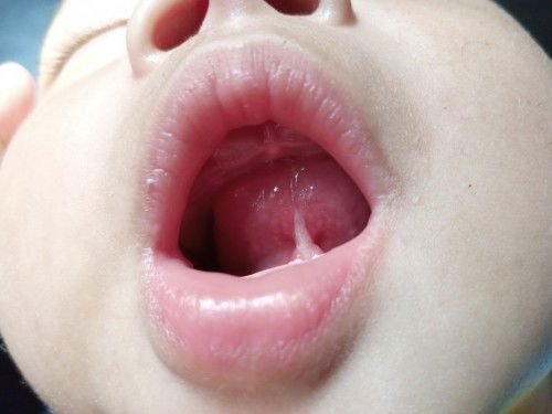 Bun ada yang tau anakku kenapa? Bawah lidah muncul putih-putih