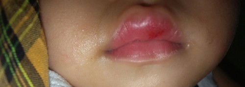 Sariawan pada bayi umur 11bulan