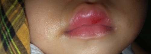 Sariawan pada bayi umur 11bulan