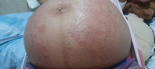 Rashes or Stretch Marks at 36weeks and 5 days?