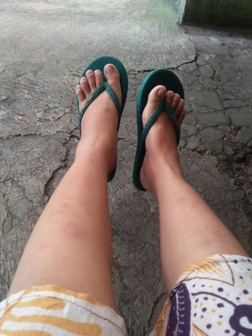 Kaki bentol" dan bengkak