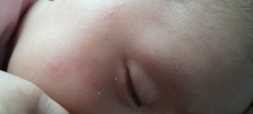 Bistik bintik putih di wajah