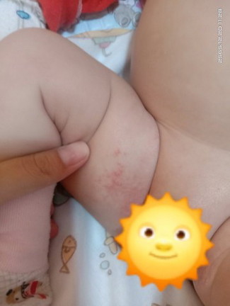 สอบถามค่ะ น้องขึ้นผื่นแบบนี้คืออะไรคะ น้องเป็นทั้ง2ข้างเลยค่ะ ใช่แพ้แพมเพิสมั้ยคะ