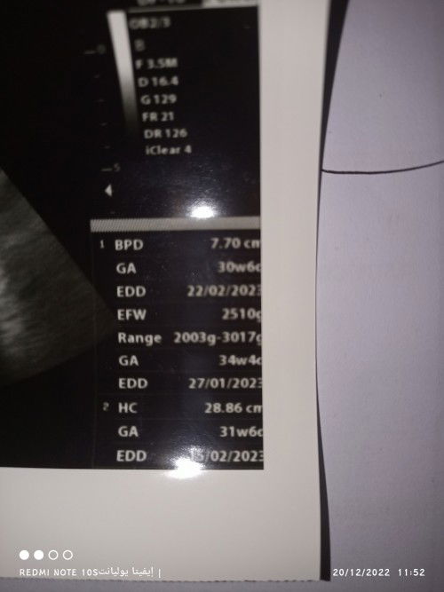 Berat janin usia 30w6d