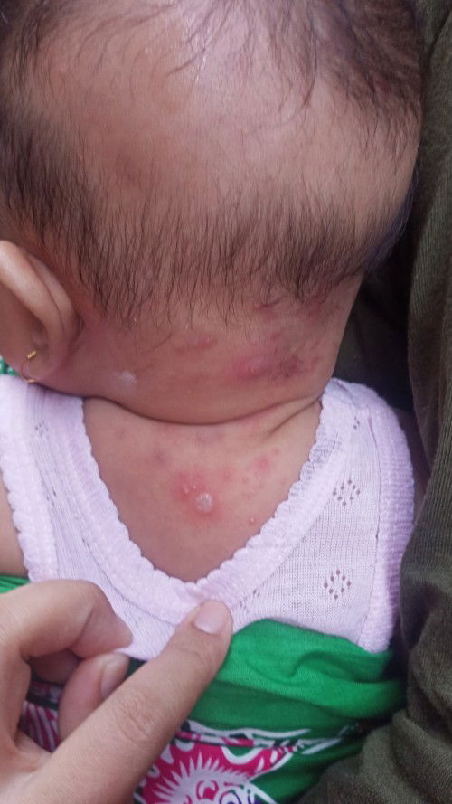 Sejenis biang keringet tapi bernanah