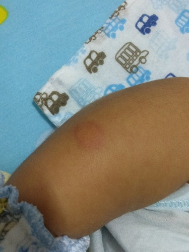 คือตุ่มอะไรค่ะ