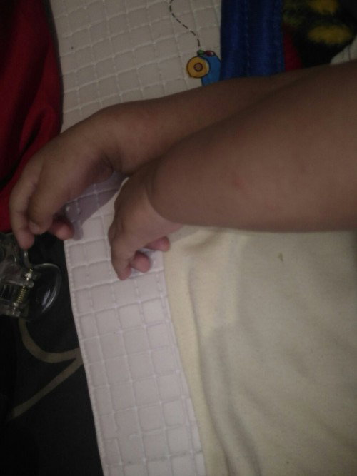 Kemerahan di tangan leher sama jidat