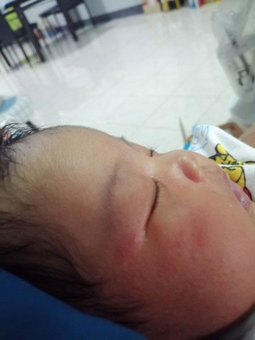 ผื่นที่หน้า