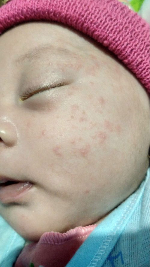 Bintik merah di pipi