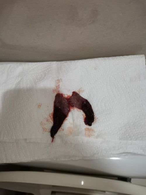 Bleeding sa Pregnancy