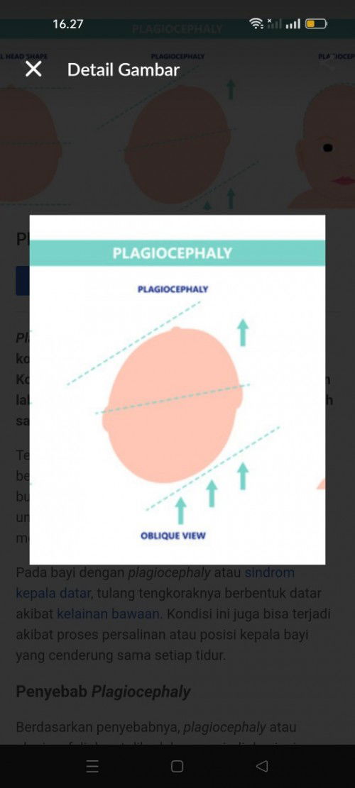 Plagiocephaly atau kepala peyang miring disatu sisi kepala