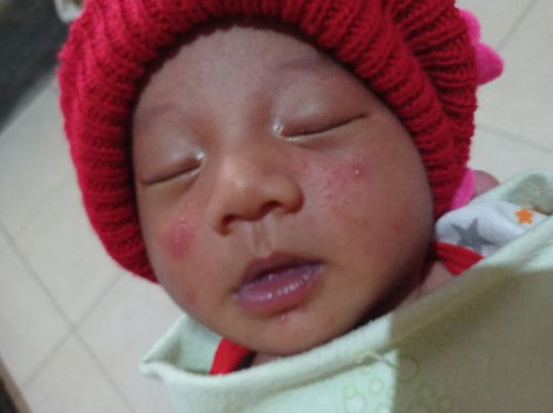 Ruam di Pipi Bayi
