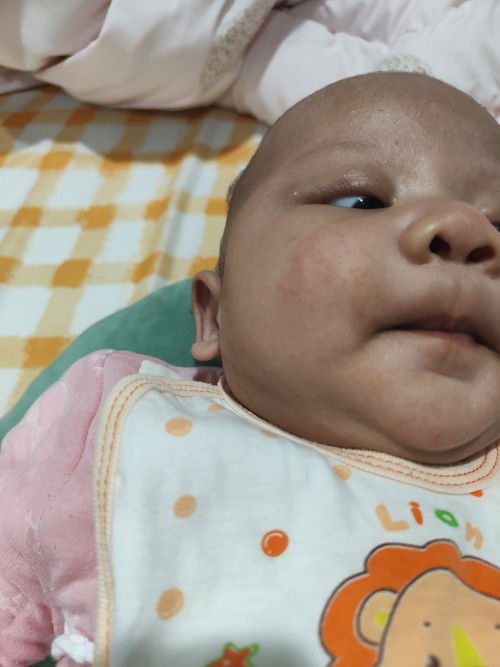 ลูกเป็นผื่นแบบนี้ที่ใบหน้า