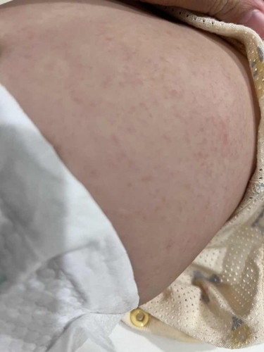 Red bumps on baby