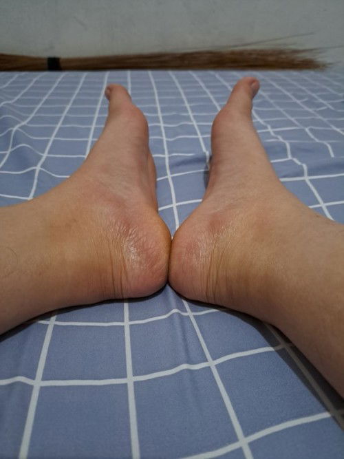 Hamil 5week 3day kaki bengkak dan memar