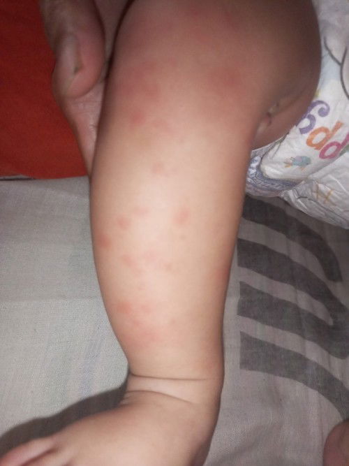 Alergi telor saat mpasi