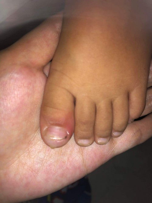 INGROWN? Need help 🥺