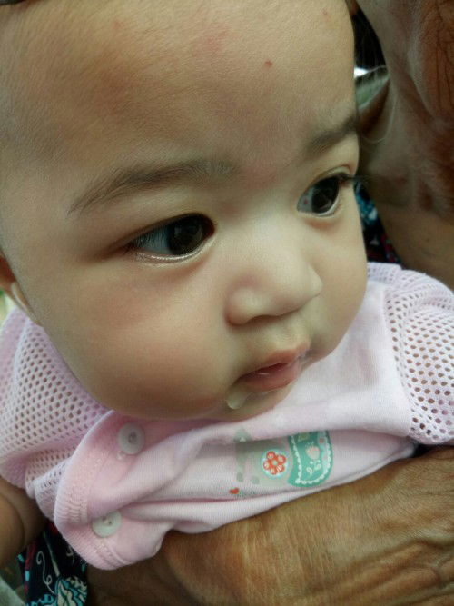 Mata baby subconjunctival hemorrhage