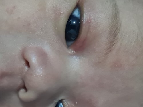 Redness sa upper eyelid ni 1month old baby ko