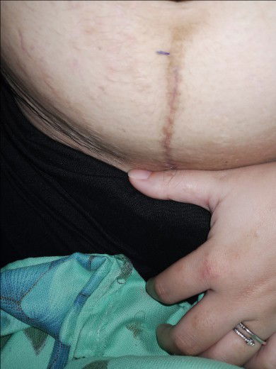 Cs follow up check up