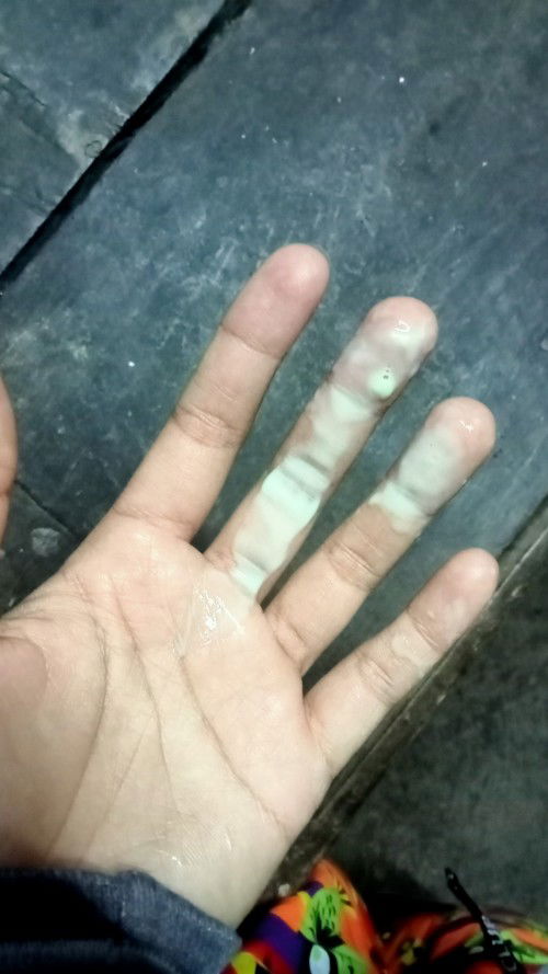 ตกขาวแบบคืออะไรคะ