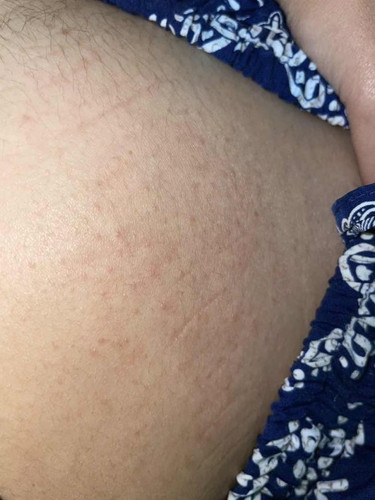 ผื่นคันรอบท้อง