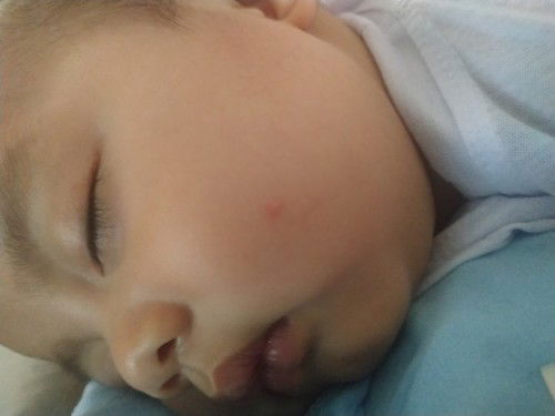 Foot hand mouth disease