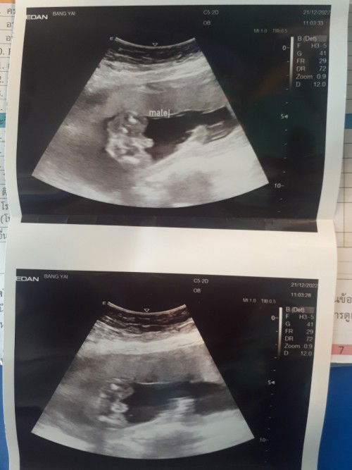 แบบนี้ ผช,ผญ ค่ะ หมอบอกน่าจะผู้ชายค่ะ