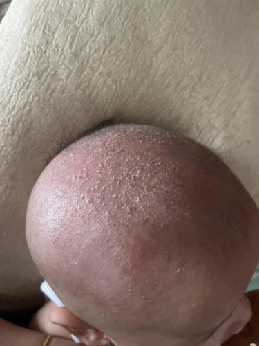 Cradle Cap