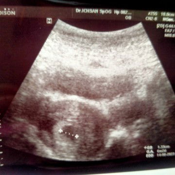 Usia kandungan saya 6 Minggu tadi saya USG hasilnya kantong janin sudah ada, tapi janin blm kelihata