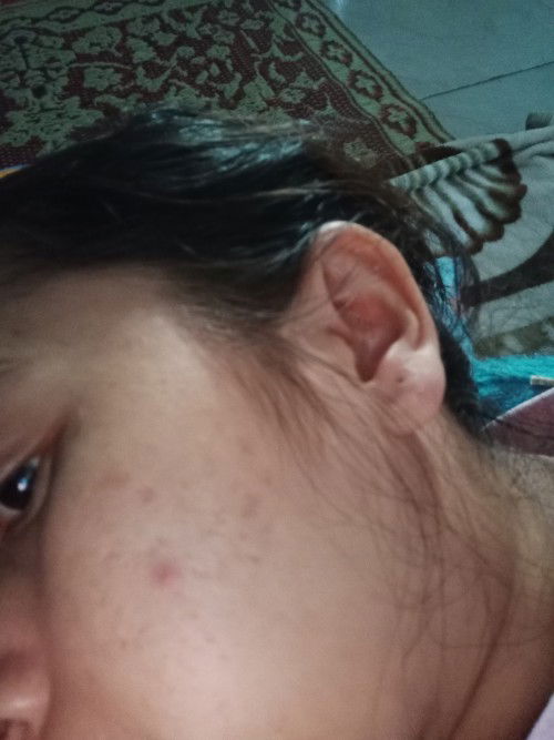 bekas jerawat habis lahiran