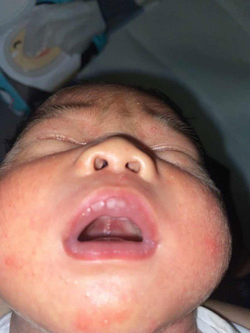 Nổi hạt trắng ở quanh lợi