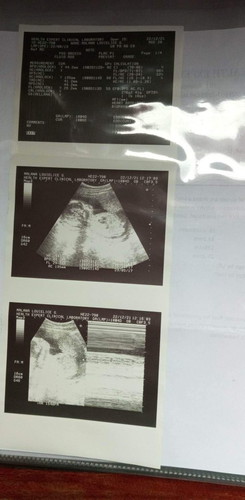 Breech Position