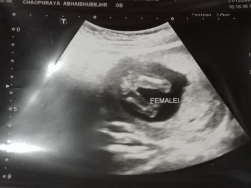 หมอบอกได้ลูกสาว มีแนวโน้มจะเปลี่ยนไปเป็นชายไหมค่ะ แต่แม่ดีใจมากค่ะ เพราะอยากได้ลูกสาว
15+3