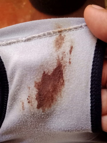 ขอสอบถามหน่อยค่ะ พอดีวันนี้หมอกระตุ้นปากมดลูก เเล้วตอนเย้นมีเลือด ควรไปหาเลยไหมคะ