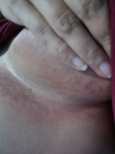Rashes under my Boobies