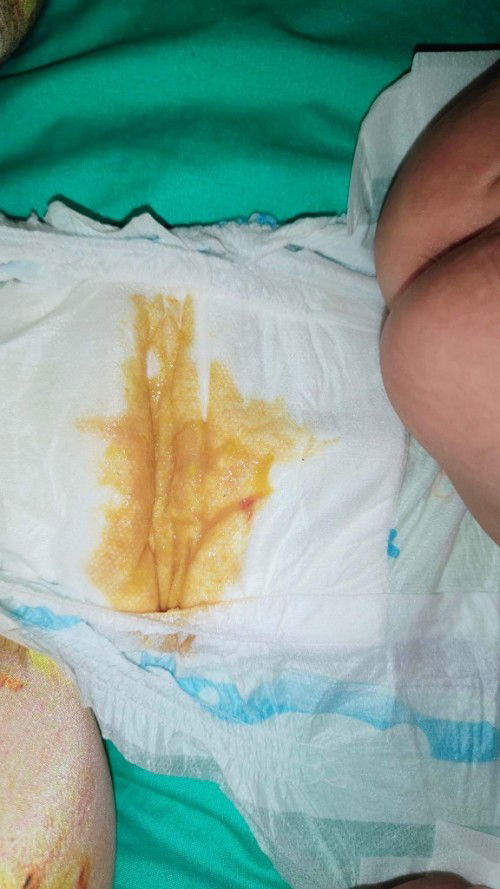 Bakit may kasamang dugo ang tae ni babay?