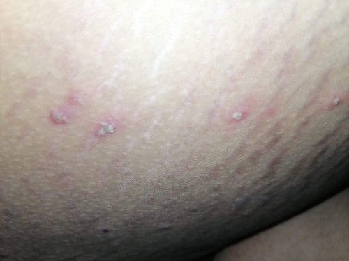 เป็นตุ้มหนองตรงข้างๆท้องเหมือนสิว