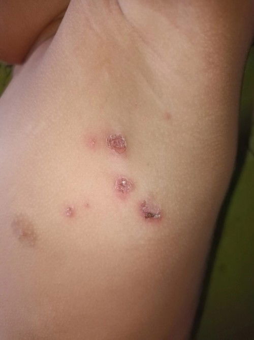 Bunn..
Ada yg tau ini apa yaa??
Udah ada seminggu lebih di sekitaran ketiak tangan anak aku.