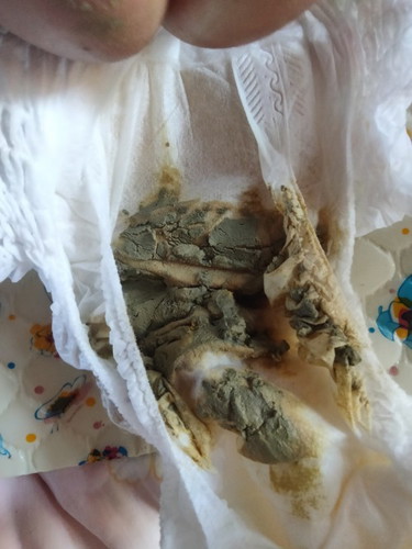 อึแบบนี้ปกติไหม