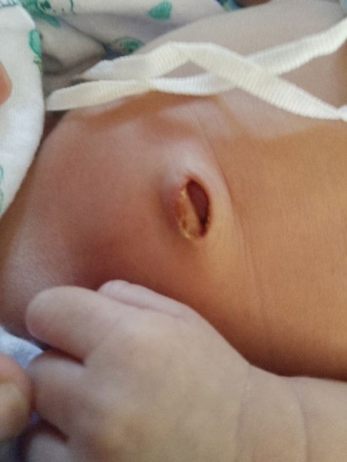 สะดือลูกหลุดแต่ไม่ค่อยเเห้ง จะเป็นอะไรไหมค่ะ ต้องทำไงดีค่ะ น้องได้9 วัรแล้วค่ะ