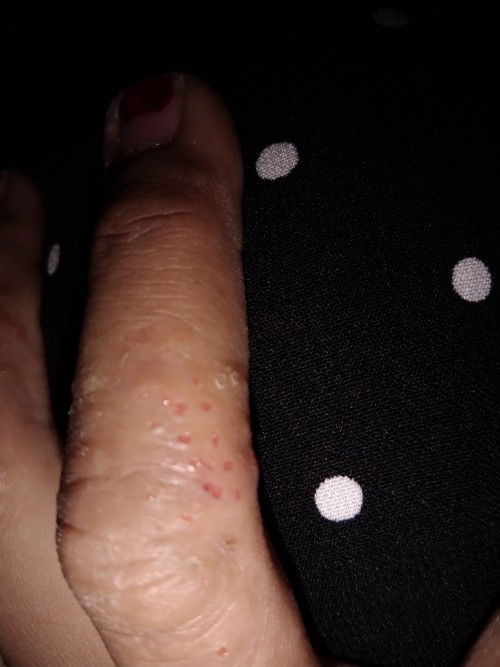 Gatal di sekujur tubuh