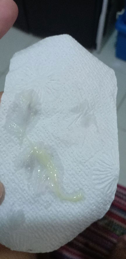 Uti or yeast infection