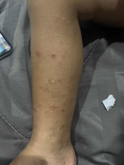 ผืนหัวแข็ง คัน