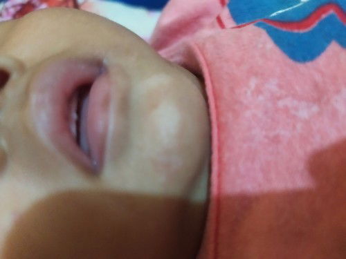 Mau tanya bun klo putih d dagu bisa ilang ga ya gmna cara ngatasinnya ya bun