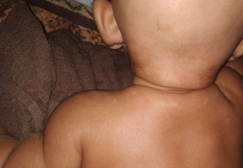 Kukit bayi tidak merata / seperti bercak putih