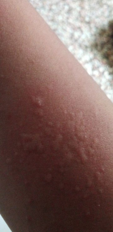 Alergi dingin setelah melahirkan