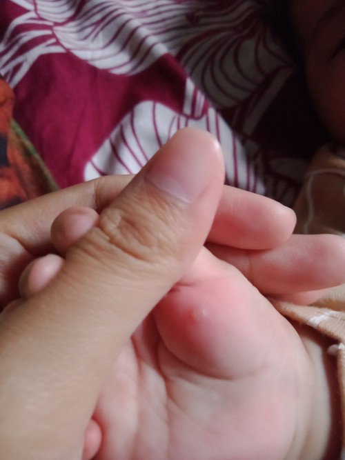 Bentol di telapak tangan